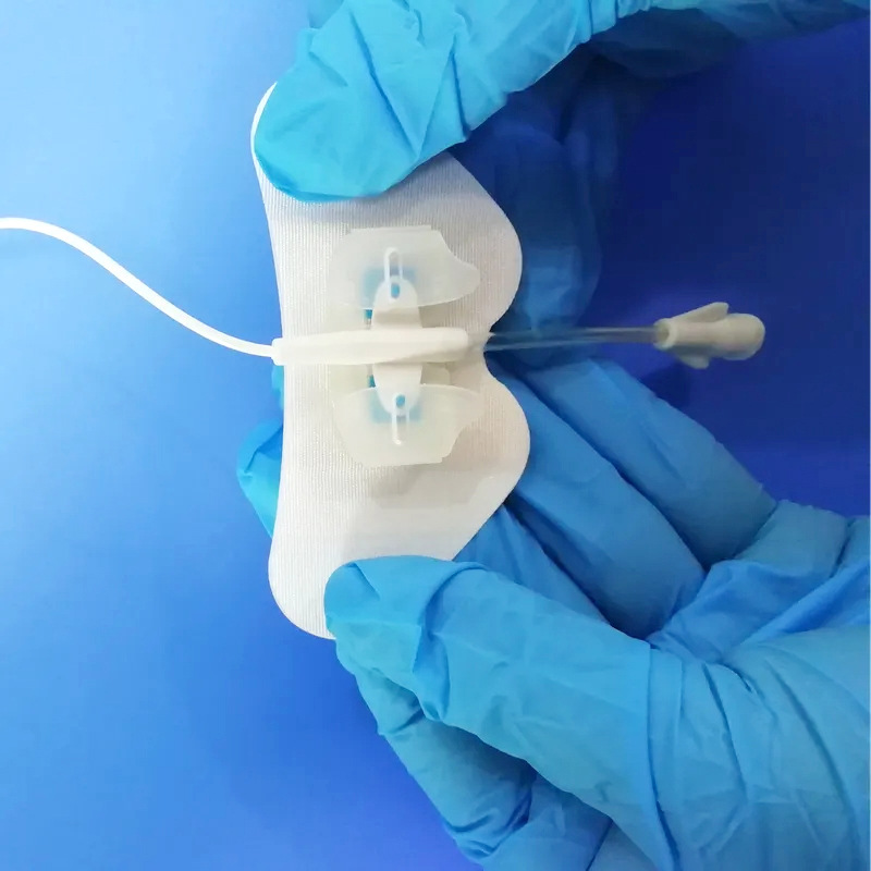 3Pcs Medical Body Surface Catheter Fixation Device Disposable PICC CVC Biliary Drainage Tube Fixing Butterfly Buckle Tape Patch