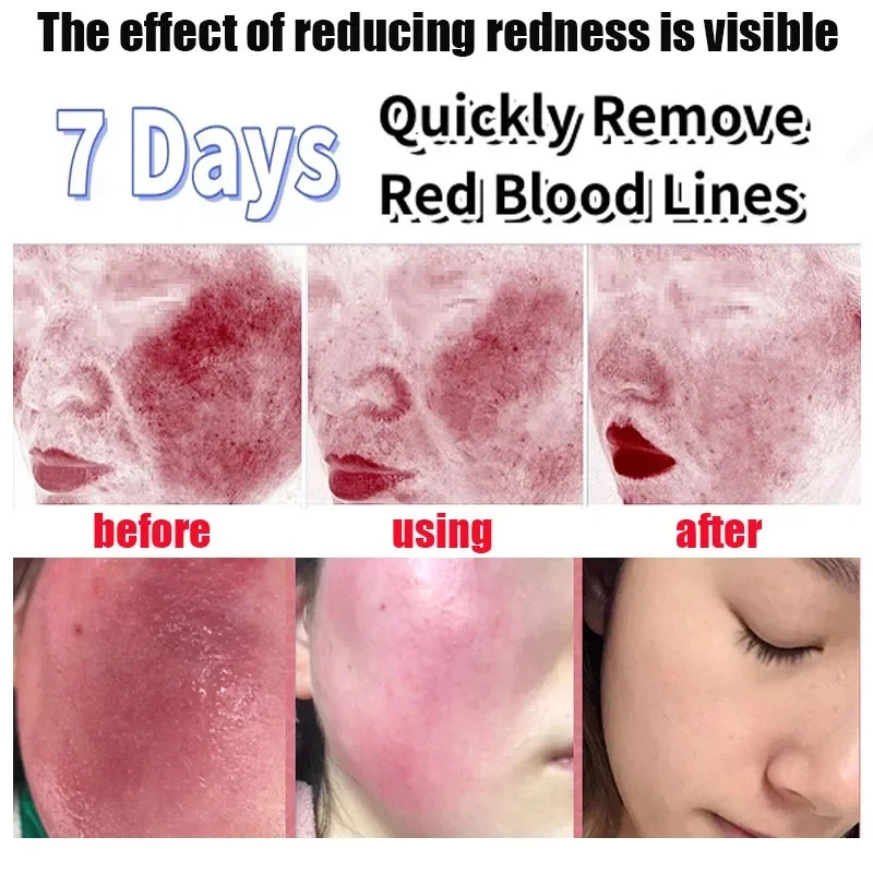 Crema reparadora de enrojecimiento Facial mejora la sequedad de la piel sensible crema hidratante loción calmante eliminación Rosacea Cosméticos Coreanos
