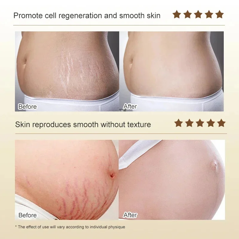 Continued use of Abdominal Scar Removal Cream eliminates signs of swelling, repairs cracks ，fades and improves fine stretch mark