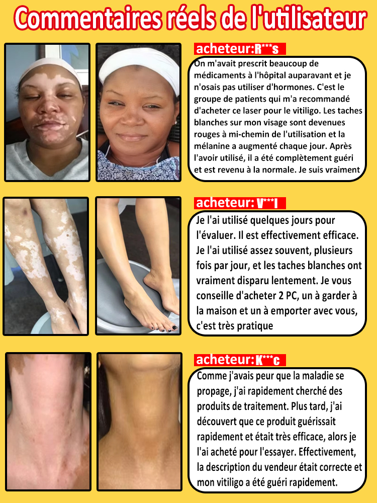 Laser vitiligo
