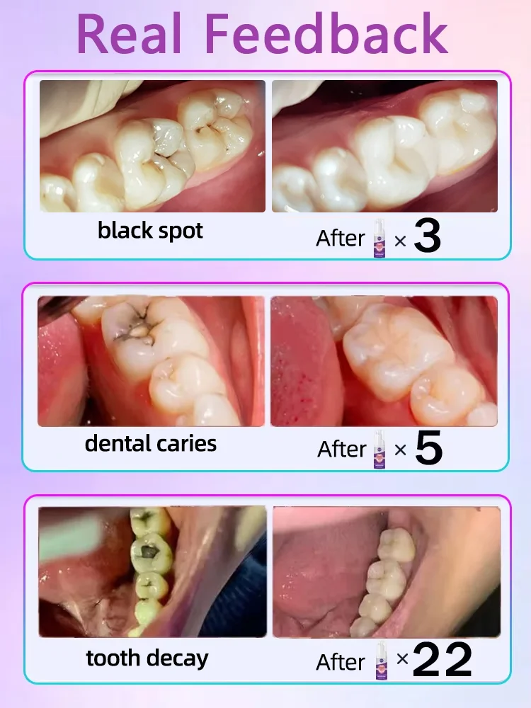 Reparación de caries dental Caries Caries Tratamiento anti-cías