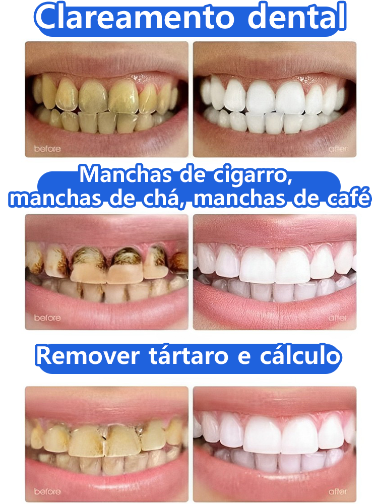 Clareamento dentário, restauração gengival rápida e natural, avaliações de usuários extremamente positivas