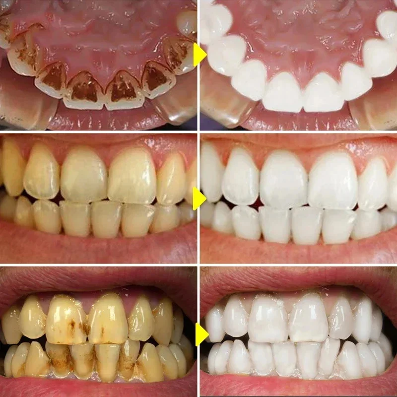 V34 pasta de dientes blanqueadora de dientes 5D tiras blanqueadoras de dientes higiene bucal limpieza herramientas de blanqueamiento Dental aliento fresco cuidado de odontología