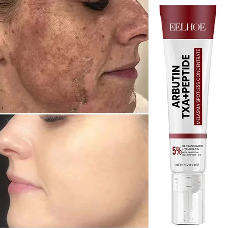 Crema blanqueadora para pecas, melasma, manchas oscuras, productos de eliminación de pigmentación, decoloración de manchas, reparación de melanina, ilumina el cuidado de la piel coreano