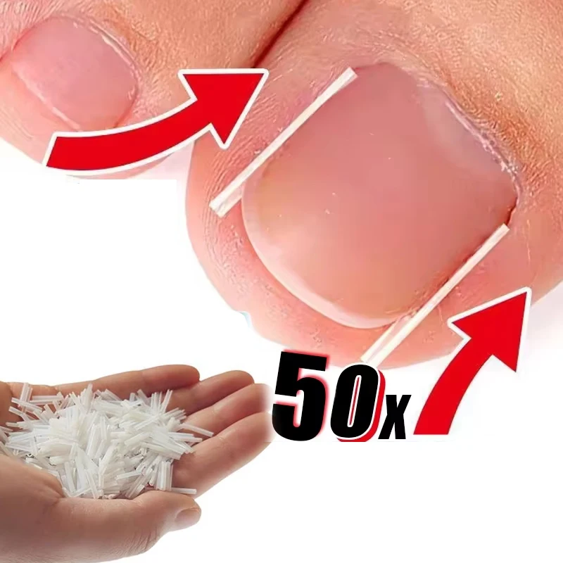Ferramenta de correção de unhas encravadas, tratamento de unhas encravadas, adesivo elástico, clipe de alisamento, ferramenta de pedicure
