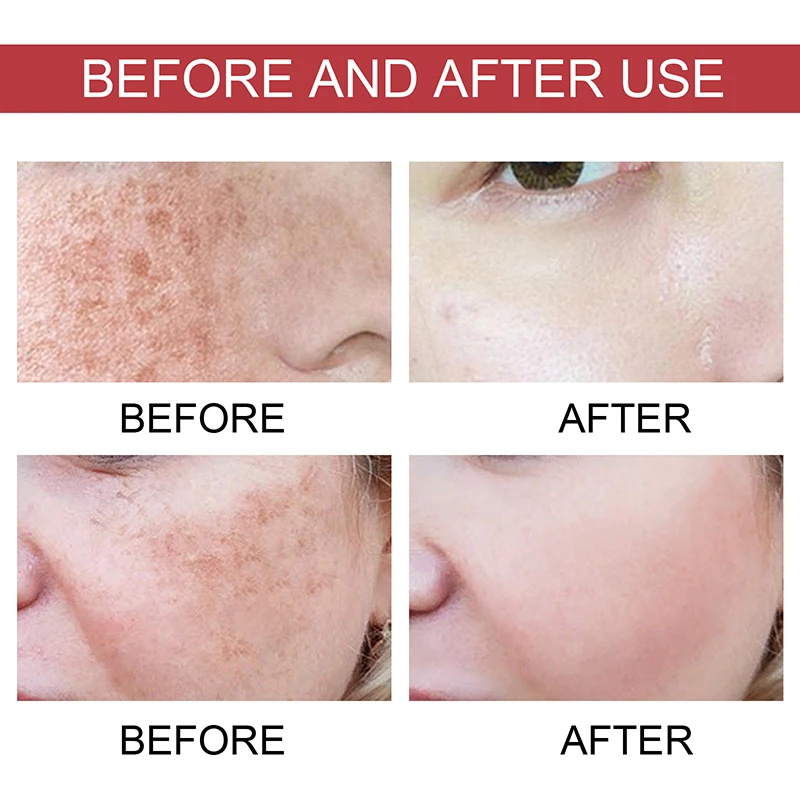 Suero de niacinamida, corrector de manchas oscuras, hidratante, brillo, decoloración de líneas finas, limpieza profunda, removedor de maquillaje, cuidado de la piel coreano