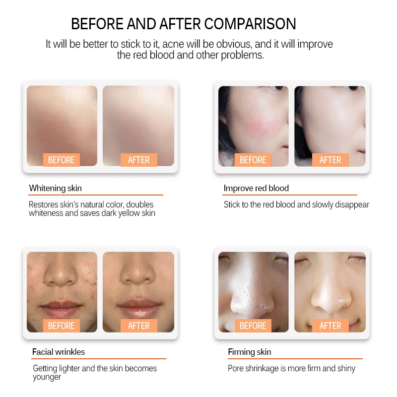 Kem Derma Cán Bút MYM Microneedling Bút Micro Vít Cổng Kim Hộp Mực BB Phát Sáng Thiết Bị Có Dây Điện Derma Dụng Cụ MTS