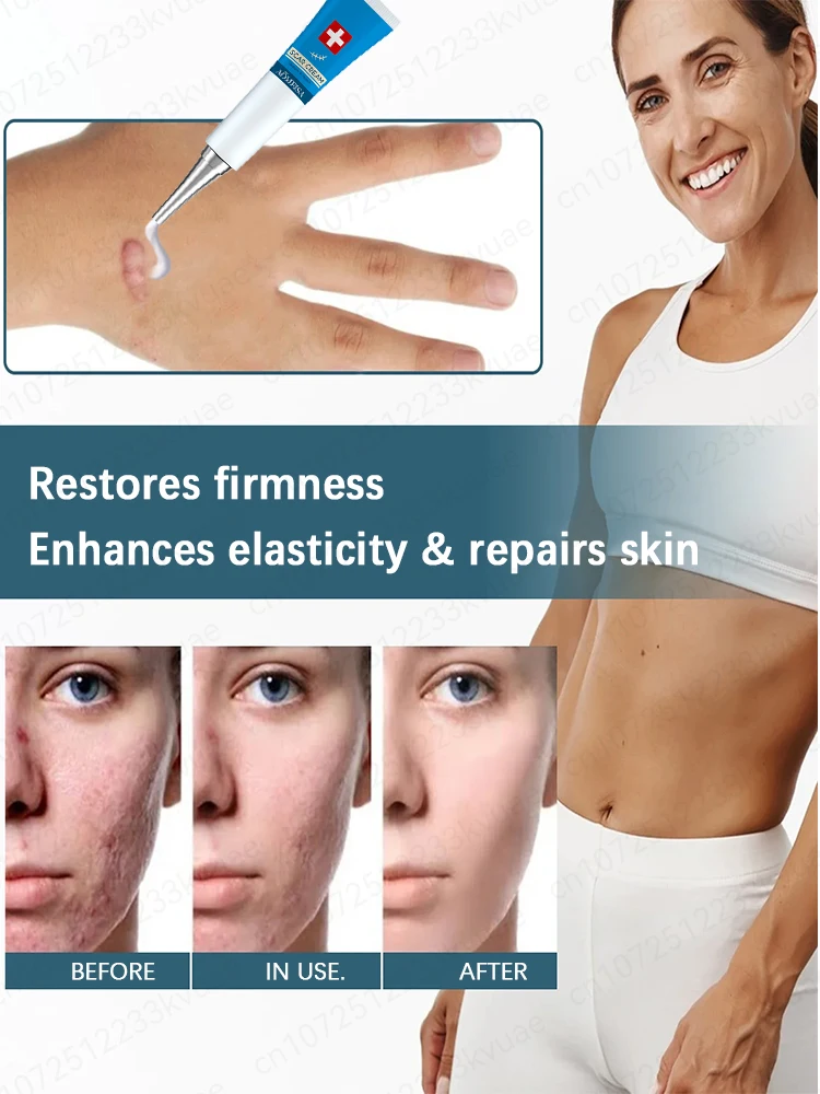 Crema para eliminar cicatrices. Elimina eficazmente las cicatrices de heridas y repara las cicatrices.