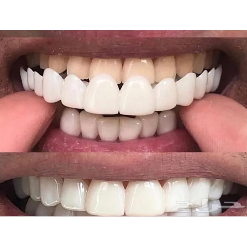 ซิลิโคนเจลทันตกรรม Upper ปลอมฟันปลอมฟันฝาครอบ Smile Veneers ฟันปลอม Braces อุปกรณ์ทันตกรรม Whitening แม่พิมพ์