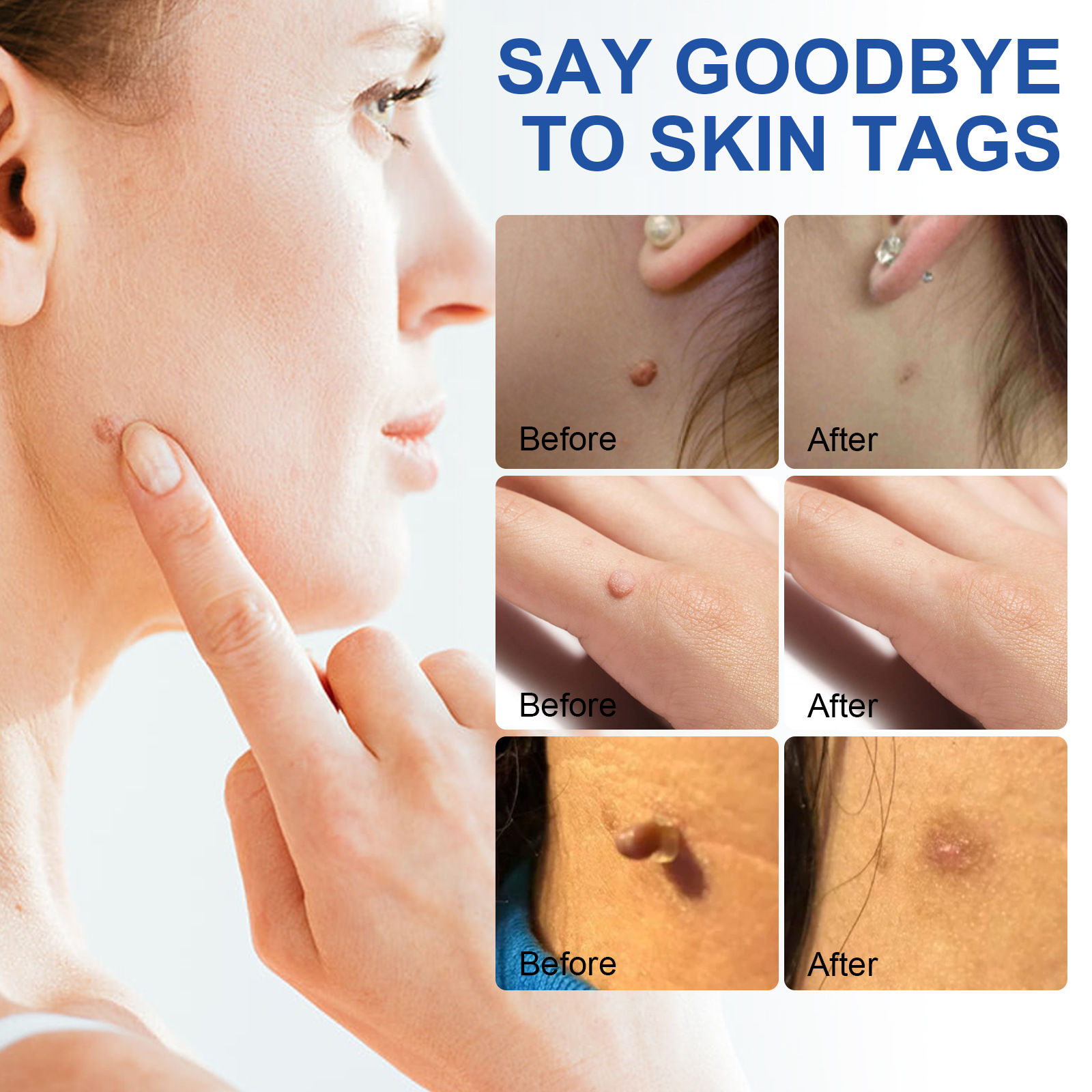 1 Set Skin Tag Removal Kit Skin Mole Wart Remover Micro Band Skin Tag Removal Kit Tag Treatment Tools Set Beauty Tools For 1-5mm