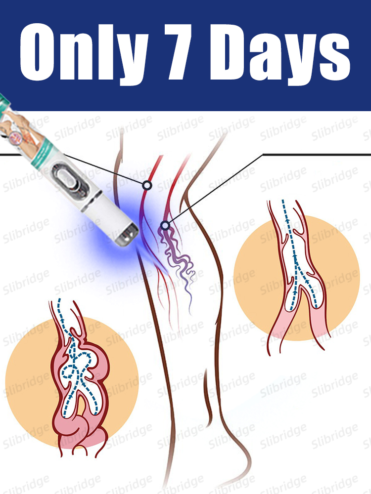 Инструменты для ухода за ногами, ручка синего света, варикозное расширение вен, горячая распродажа 2025 года.