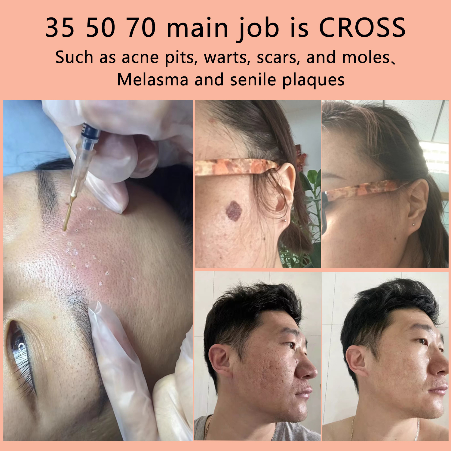 TCA、TCAピーリングパッド、Tcaケミカルピールパッド、75パッド入りボックス、20 30 35 50 70通常の顔ボディクリーニング用、クロス、