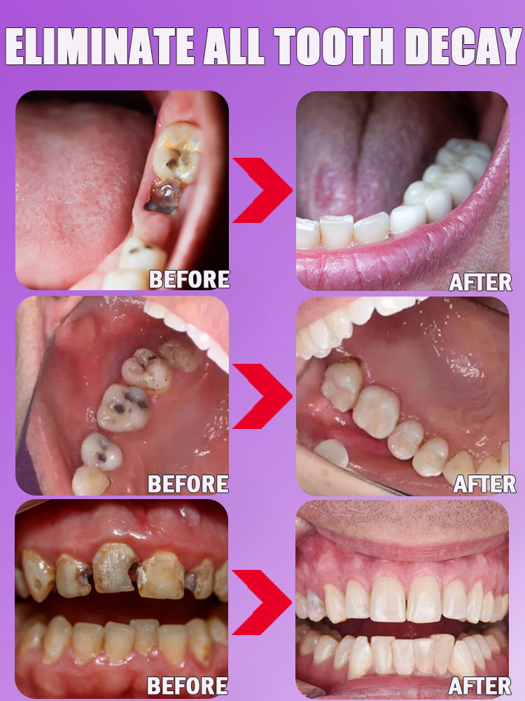 caries reparar todas las caries dentífrico Proteger los dientes