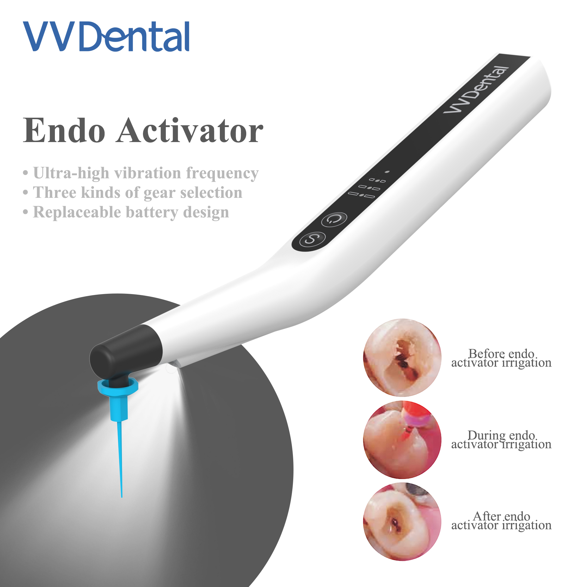 VVDental Sonic Irrigator เคล็ดลับ Endo Activator พร้อมไฟ LED สําหรับเครื่องมือทันตกรรม Root Canal Sonic Irrigator Endodontic เครื่องมือ