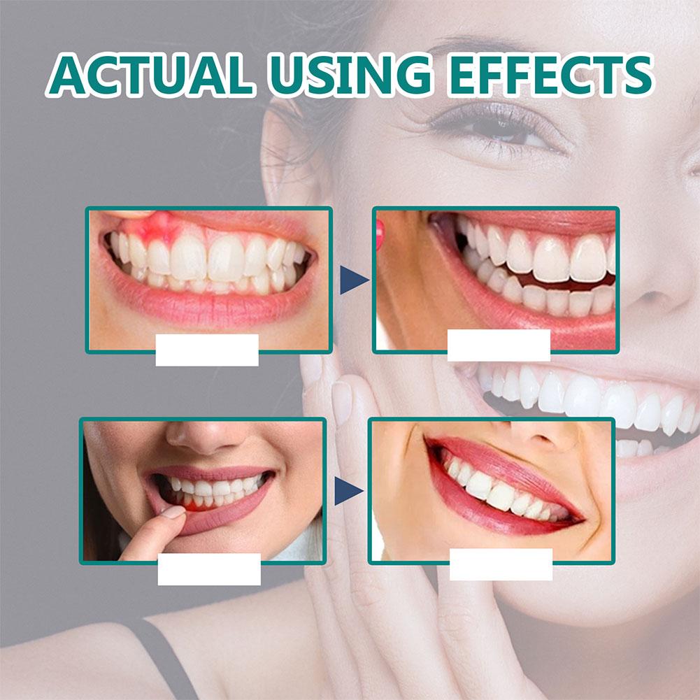 Gotas reparadoras gengivais para homens e mulheres, clareamento dos dentes, tratamento gengival periodontal, faringite, limpeza da dor oral, antibactérias, 30ml