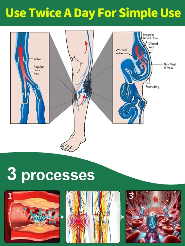 Generation-2 Laser Says Goodbye To Spider Legs Varicose In 7 Days