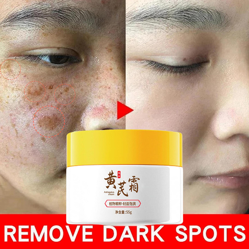 Astragalus Whitening Sproeten Crème Gezicht Donkere Vlekken Remover Reparatie Producten Verwijdering Melasma Melanine Moisturiz Fleuren Huidverzorging