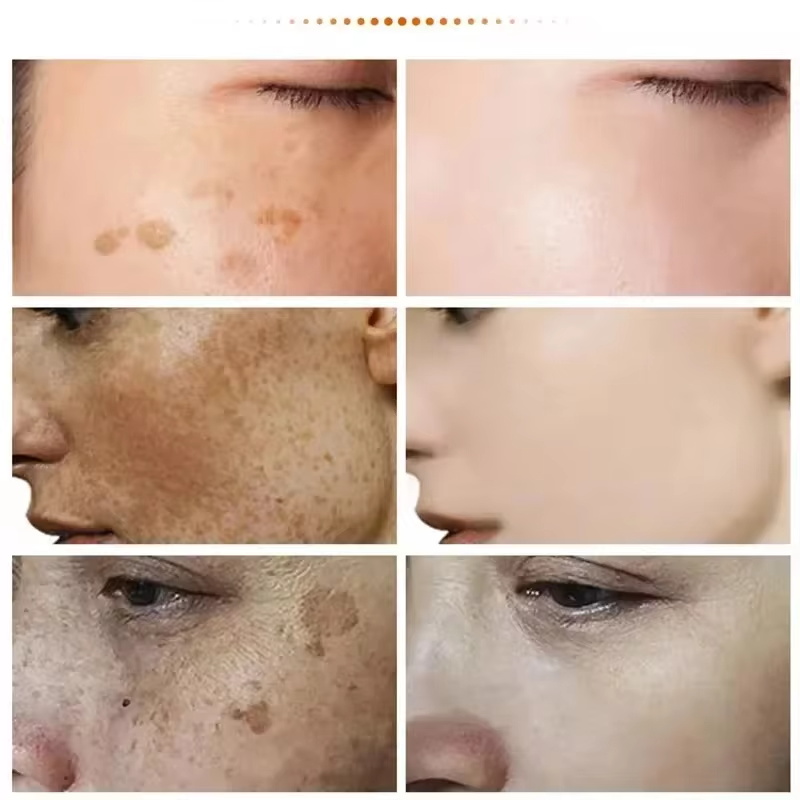 Potente crema blanqueadora eliminadora de manchas, ilumina la piel, elimina la pigmentación de melanina, Melasma, manchas oscuras, cuidado coreano de la piel