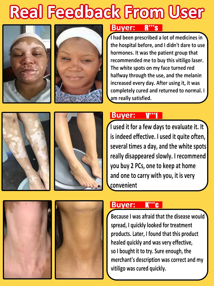 laser vitiligo