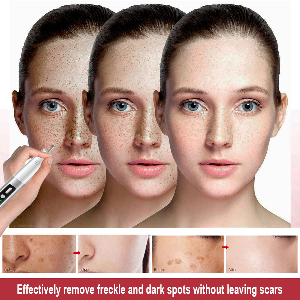 Plasma-Stift, Entfernung von Maulwurfswarzen, dunklen Flecken, schwarzer Punkt, Nevus, Sommersprossen, flacher Makel, Pickel-Entferner für Gesicht, Körper, Hautflecken-Entferner