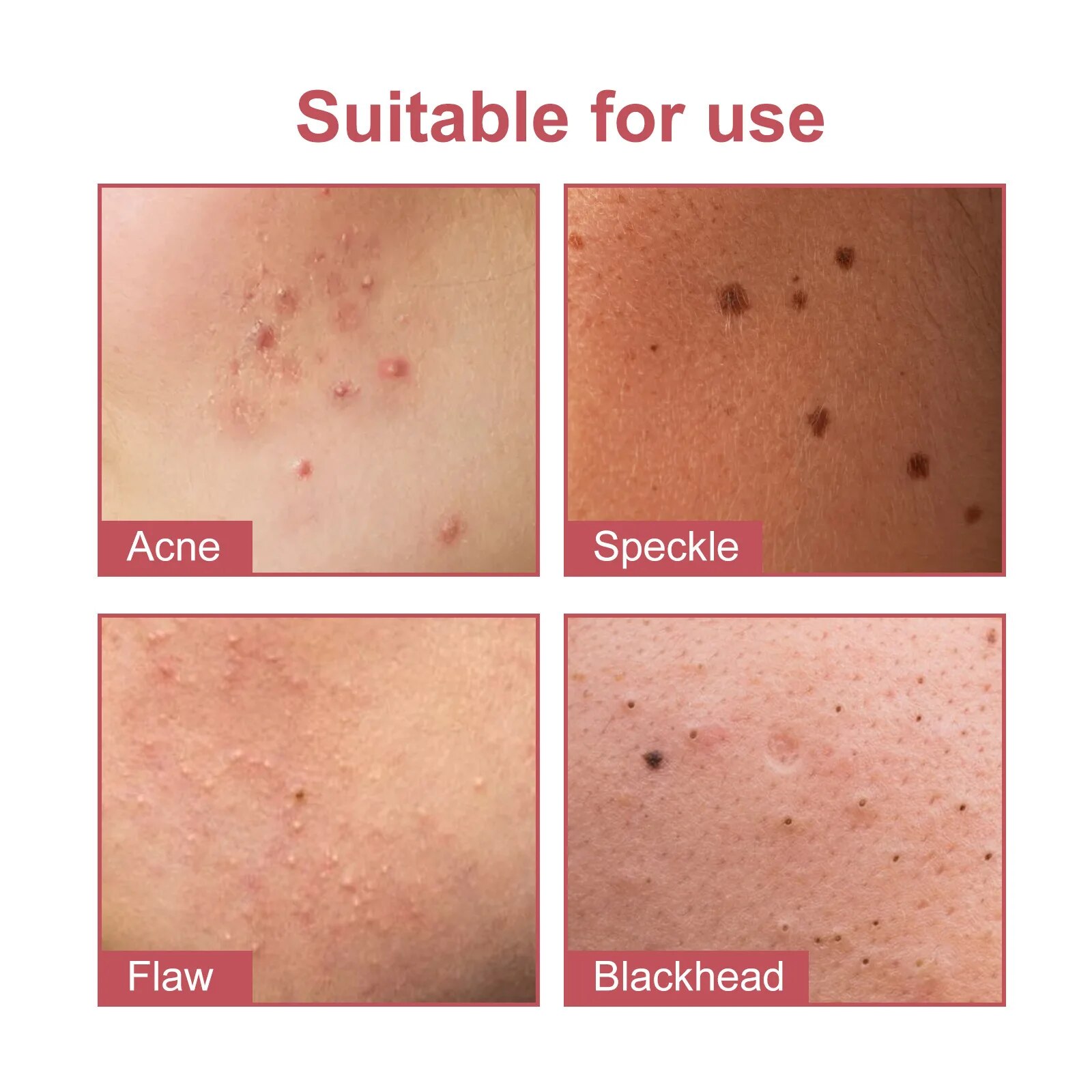 Star Acne Patch Fade Away, Pimple Marks, Poro limpo, Pele lisa, portátil, pentagrama colorido, 144pcs