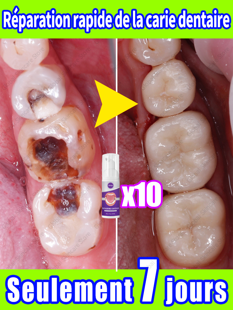 ToChaînes Réparation de la carie