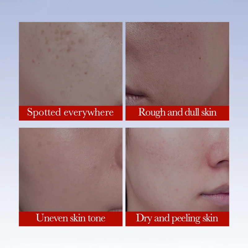 SADOER crema antipecas cremas blanqueadoras faciales eliminación de manchas antienvejecimiento hidratante eliminación de pecas crema Facial cuidado de la piel