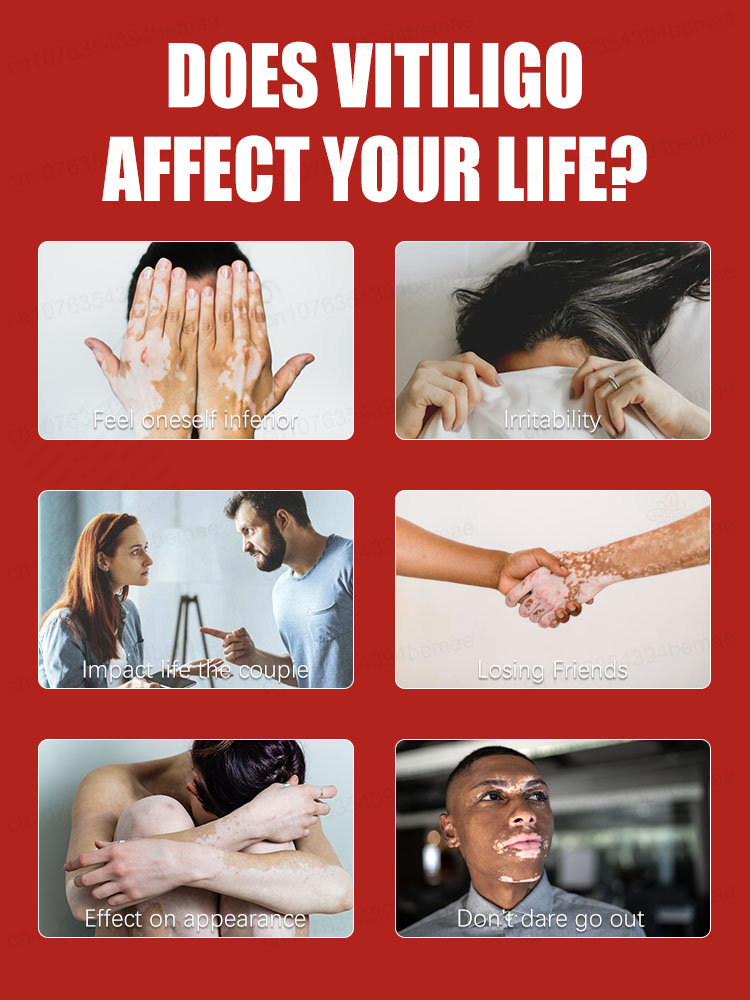 лазерный витилиго