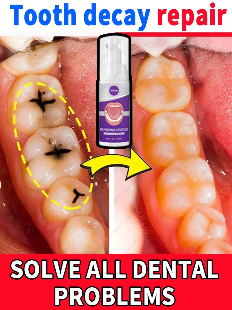 Hot selling Tooth Mousse repair tooth decay removal