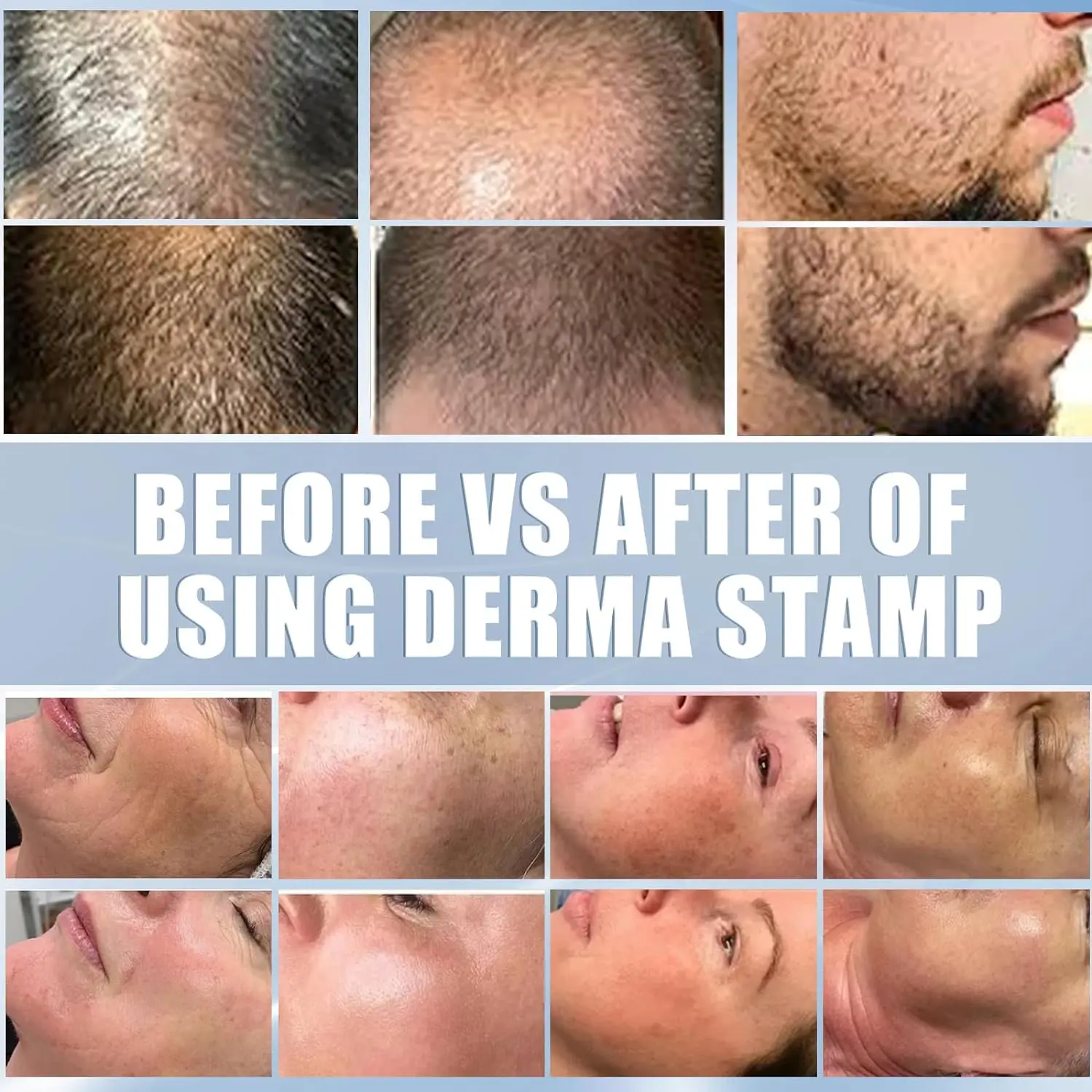 Derma Stamp Microneedling ajustável com agulhas de 140 pinos, cuidados com o corpo, cabelo, crescimento da barba
