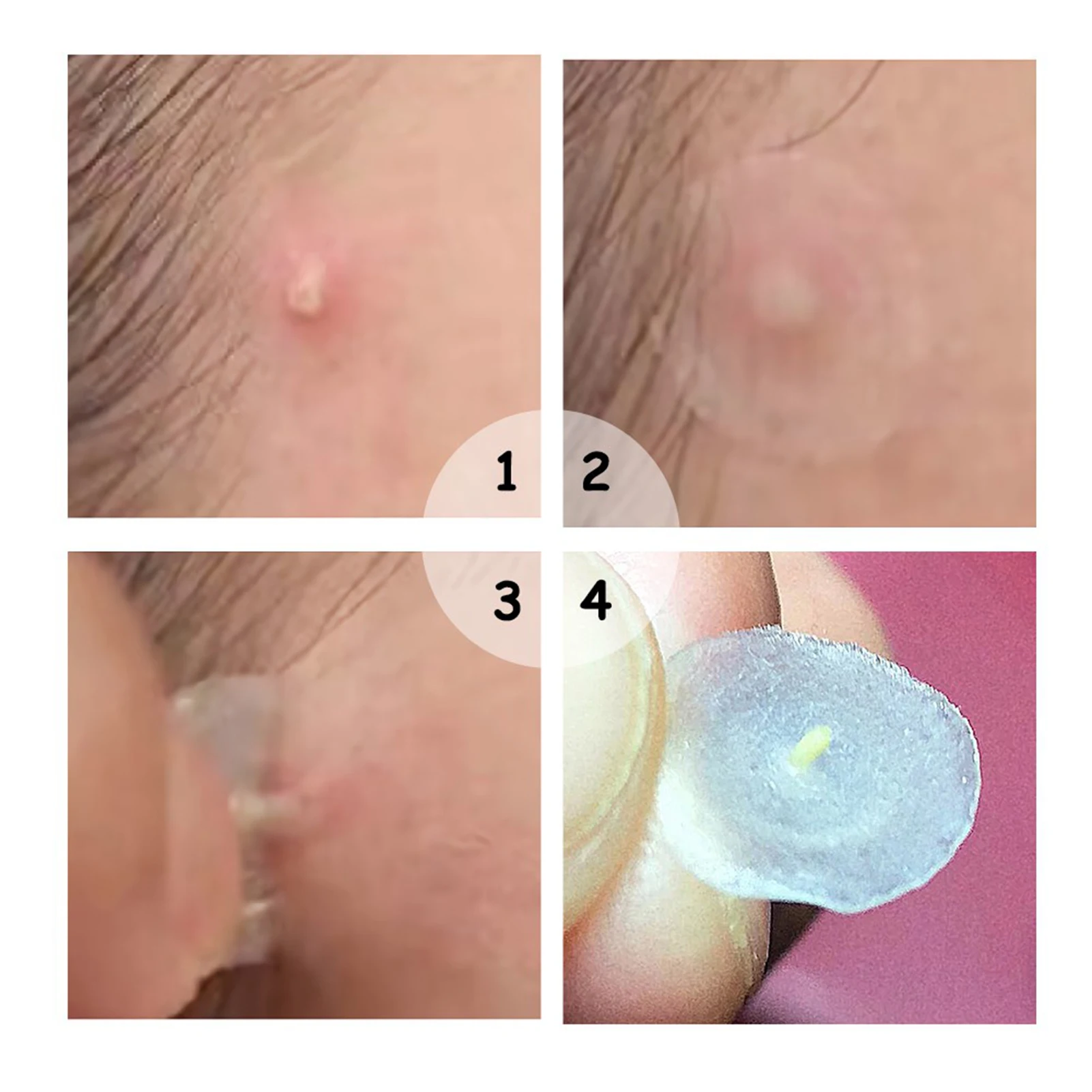 【ขายร้อน】 72 ชิ้นที่มองไม่เห็นกําจัดสิวป้องกันสิวไฮโดรคอลลอยด์แพทช์จุดเครื่องหมายคอนซีลเลอร์กันน้ําซ่อมสติ๊กเกอร์