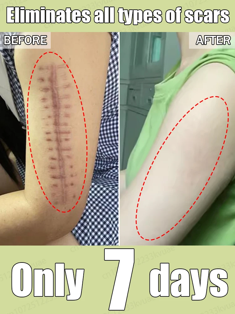 Crema para eliminar cicatrices. Elimina eficazmente las cicatrices de heridas y repara las cicatrices.