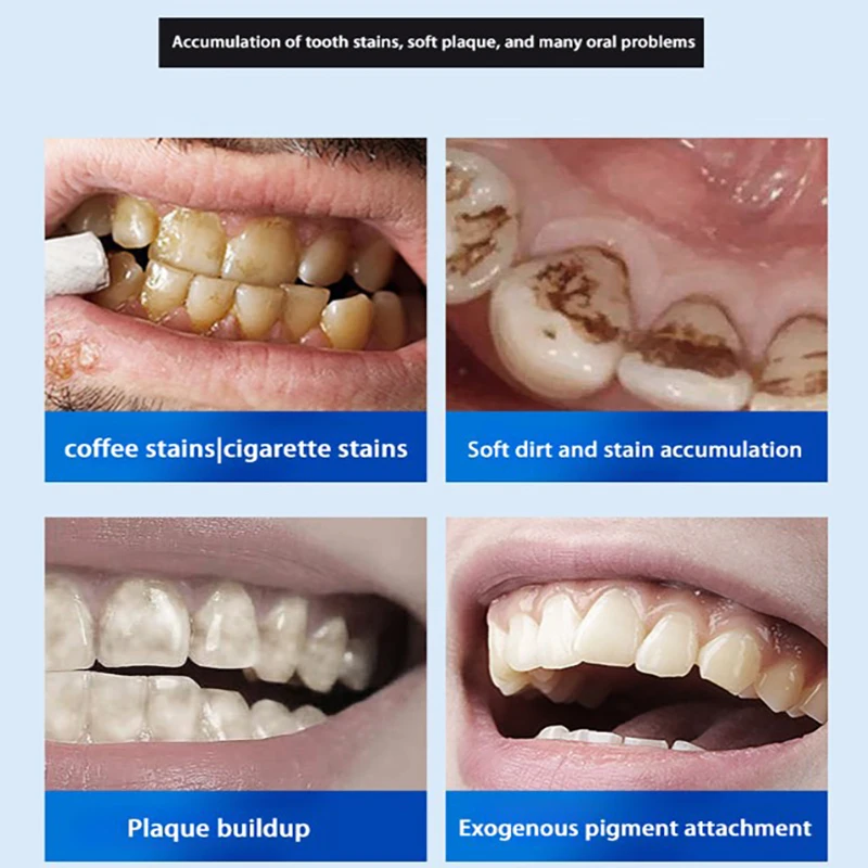Enzyme Probiotic Whiten Toothpaste Remove Stains Freshen Breath Reduce Oral Bacteria Prevent Periodontitis Fluoride Toothpaste