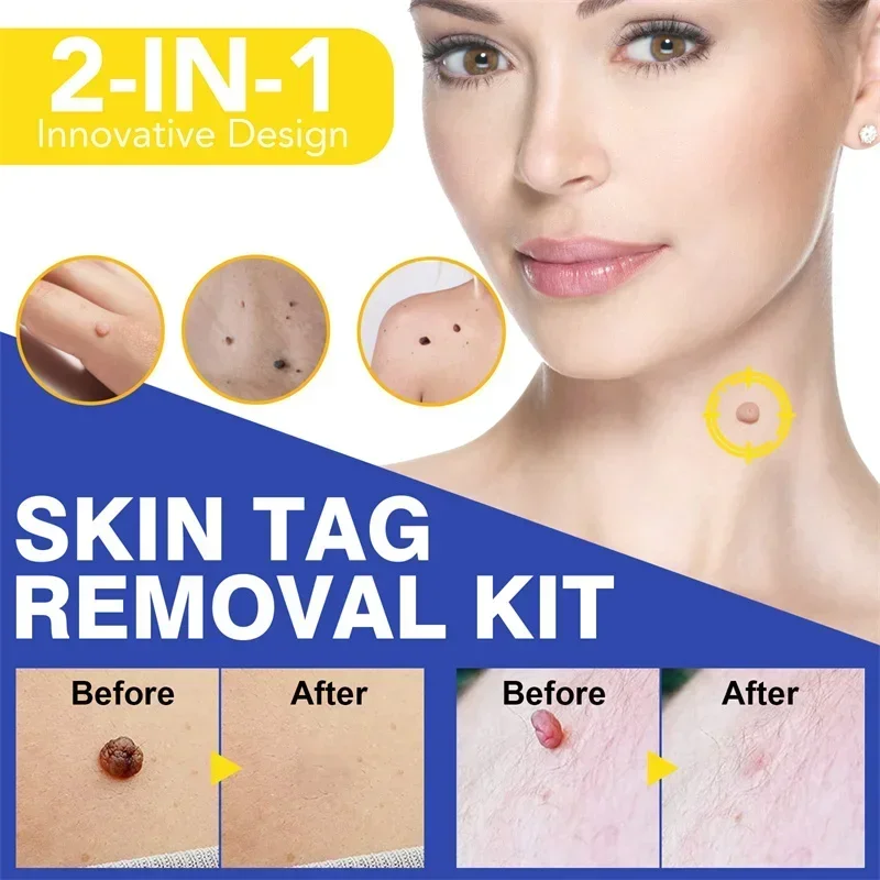 1 Set Skin Tag Removal Kit Skin Mole Wart Remover Micro Band Skin Tag Removal Kit Tag Treatment Tools Set with Cleansing Swabs