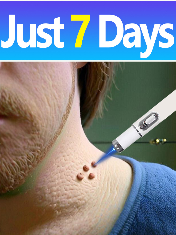 2025 New Upgrade Blue Laser Solve Wart Tool