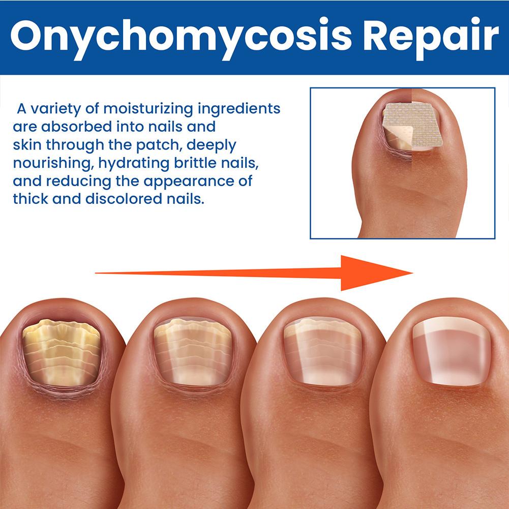 Parches de piezas para uñas de los pies, accesorio de reparación de uñas de los pies, no irritante y transpirable, 60 unidades