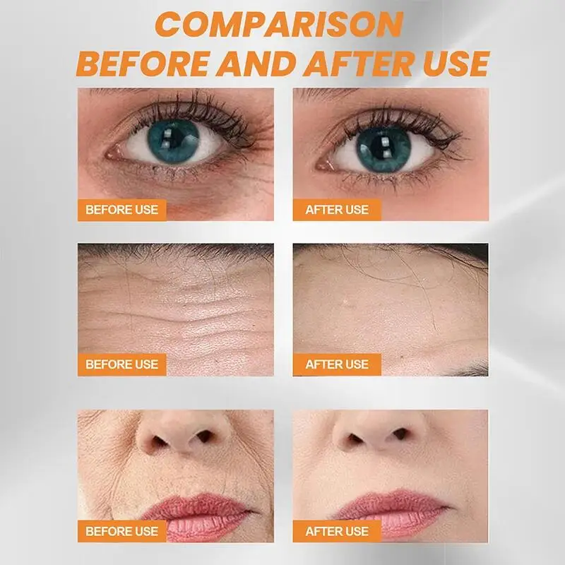 Removedor instantâneo de rugas, proteína de colágeno, conjunto de soro, levantamento, endurecimento, solúvel, absorvente, enchimento facial, anti-envelhecimento, cuidados com a pele