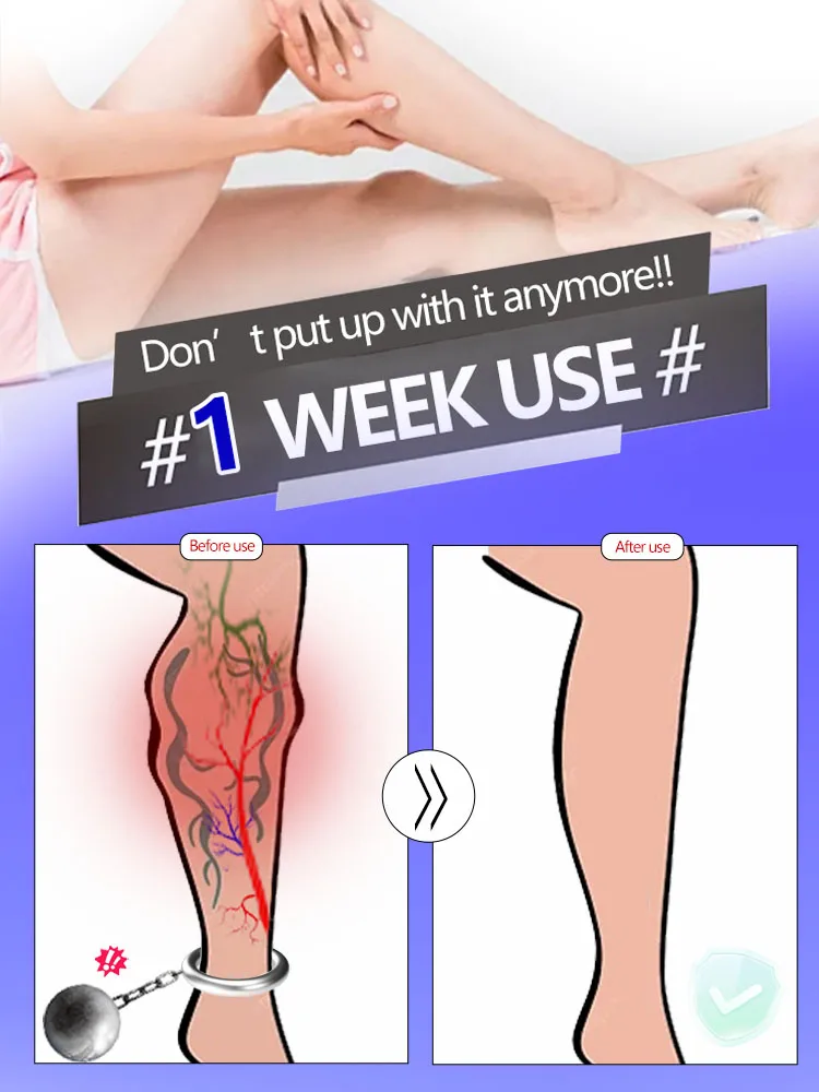 2025 Hot sale Vein blue light tool, more discounts on sets Leg care tools say goodbye to varicose veins