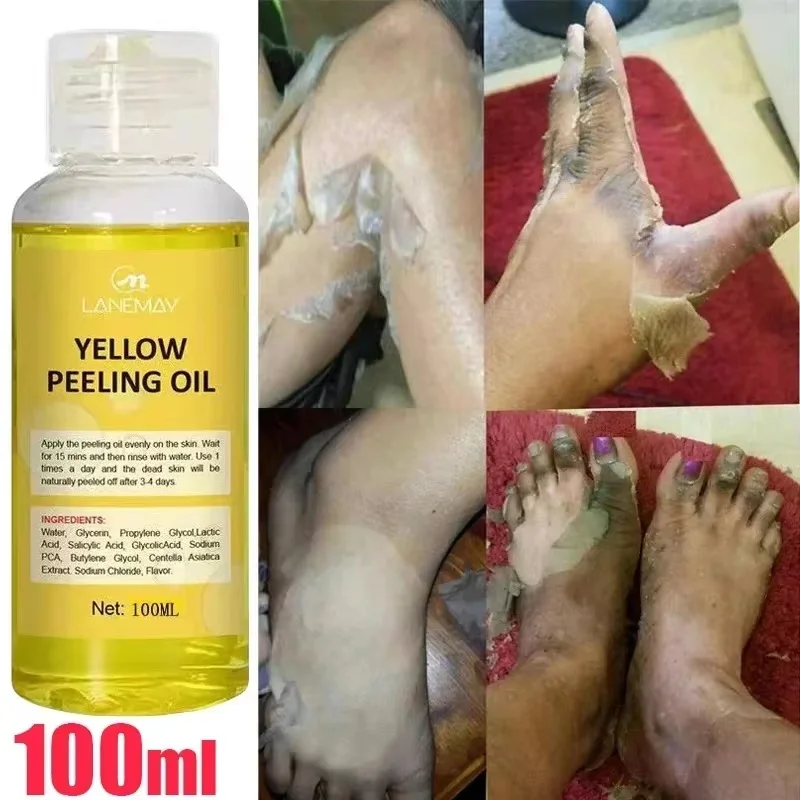 Olio Peeling giallo siero esfoliante per la cura della pelle morta sbiancamento della pelle scura rimuovere le gambe del ginocchio del braccio melanina Body Brighten Scrub Whiten