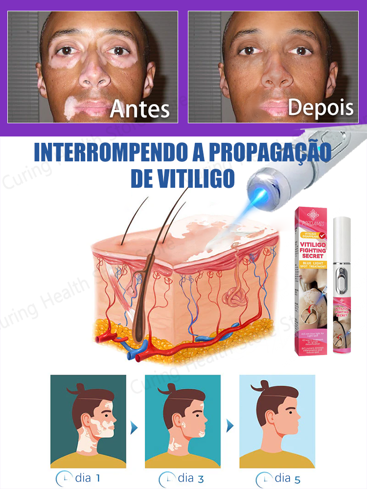 vitiligo laser
