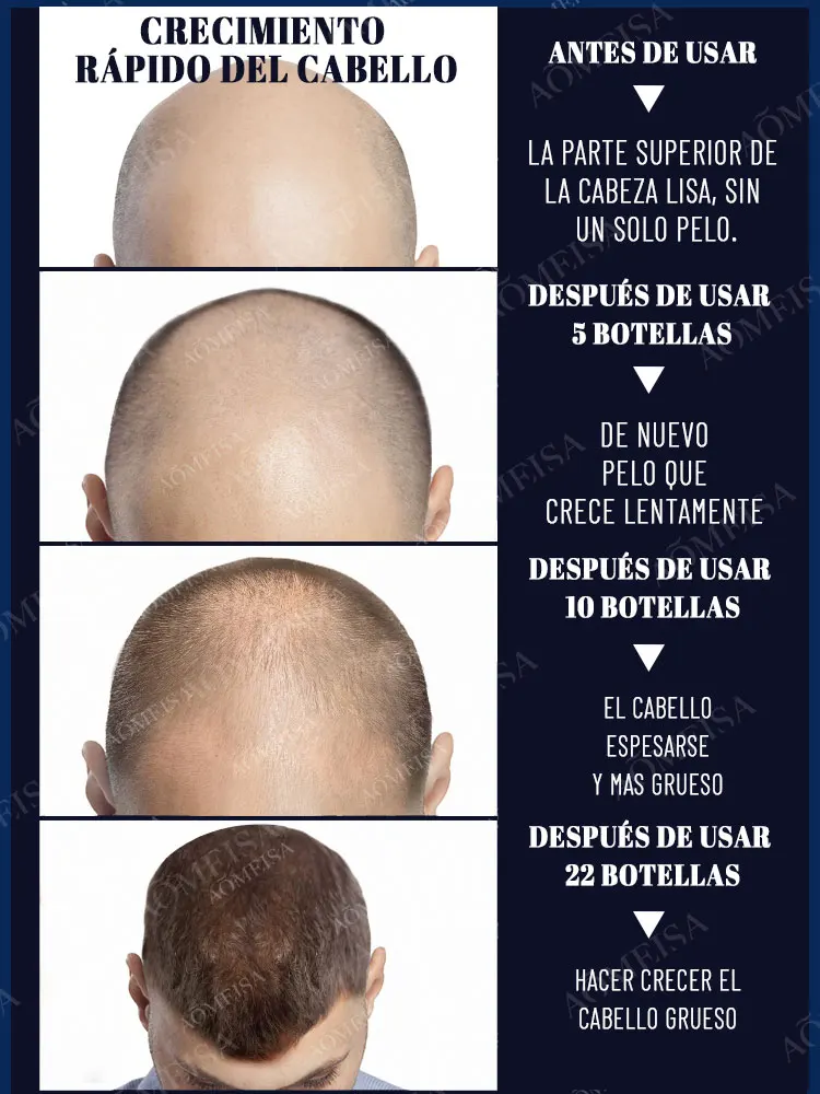 La pequeña botella azul de WPRBREGT nutre profundamente el cuero cabelludo, revitaliza los folículos pilosos y promueve el crecimiento rápido del cabello en 7 días.