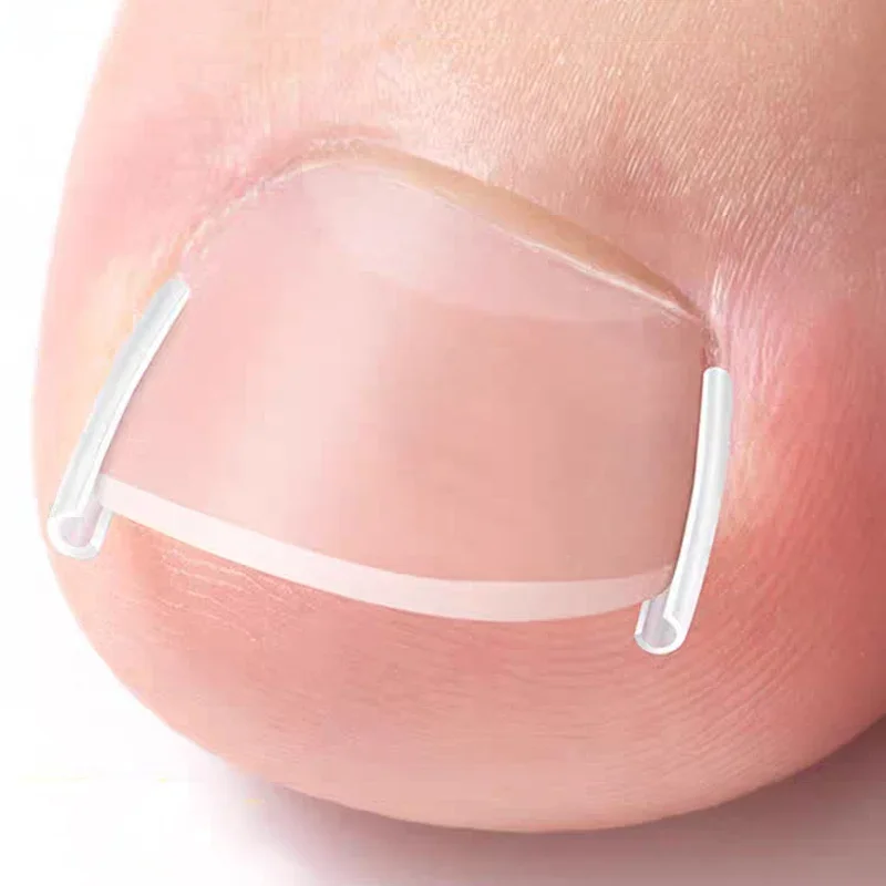 Almohadilla de tubo elástica en forma de C para uñas de los pies, Corrector de uñas encarnadas, herramientas para el cuidado de los pies, tratamiento de Clip alisador de ranura Invisible