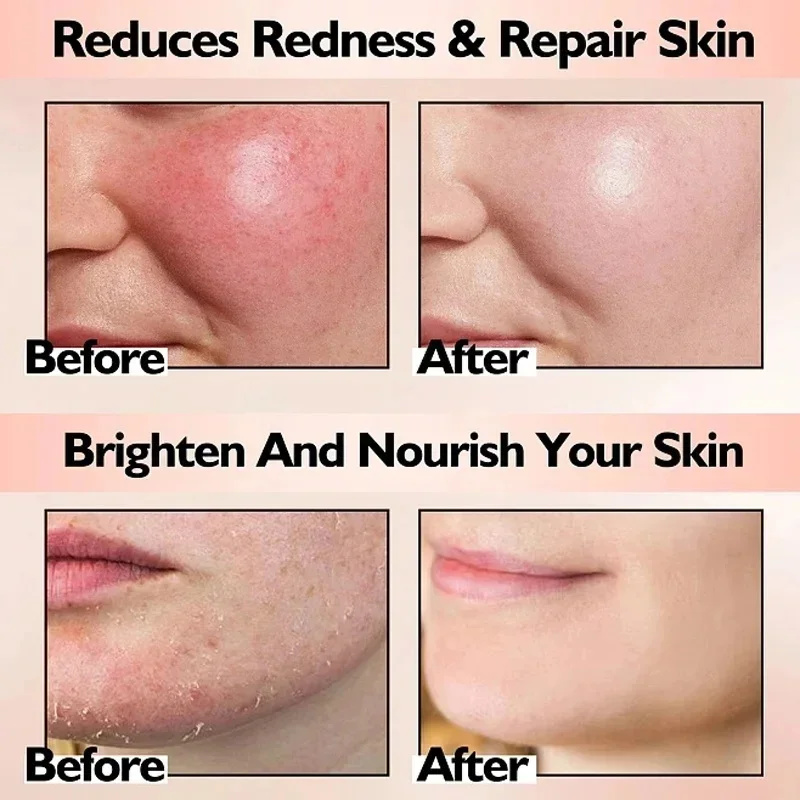 Crema reparadora de enrojecimiento Facial mejora la sequedad de la piel sensible crema hidratante loción calmante eliminación Rosacea Cosméticos Coreanos