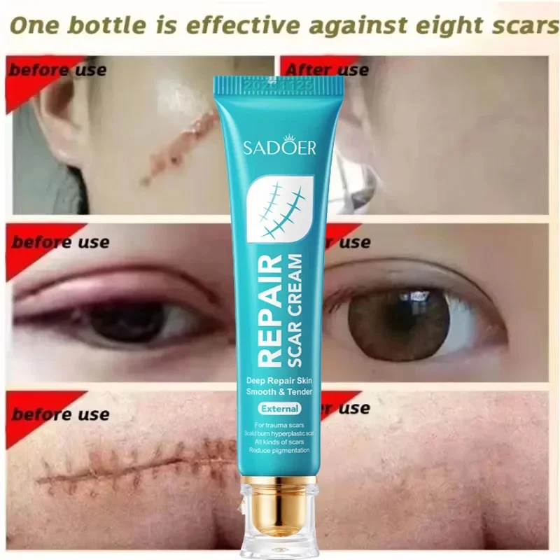 Crema para eliminar cicatrices, reparación de estrías, quemaduras de acné, ungüento quirúrgico para cicatrices de acné, tratamiento a base de hierbas, Gel blanqueador, belleza, cuidado de la salud