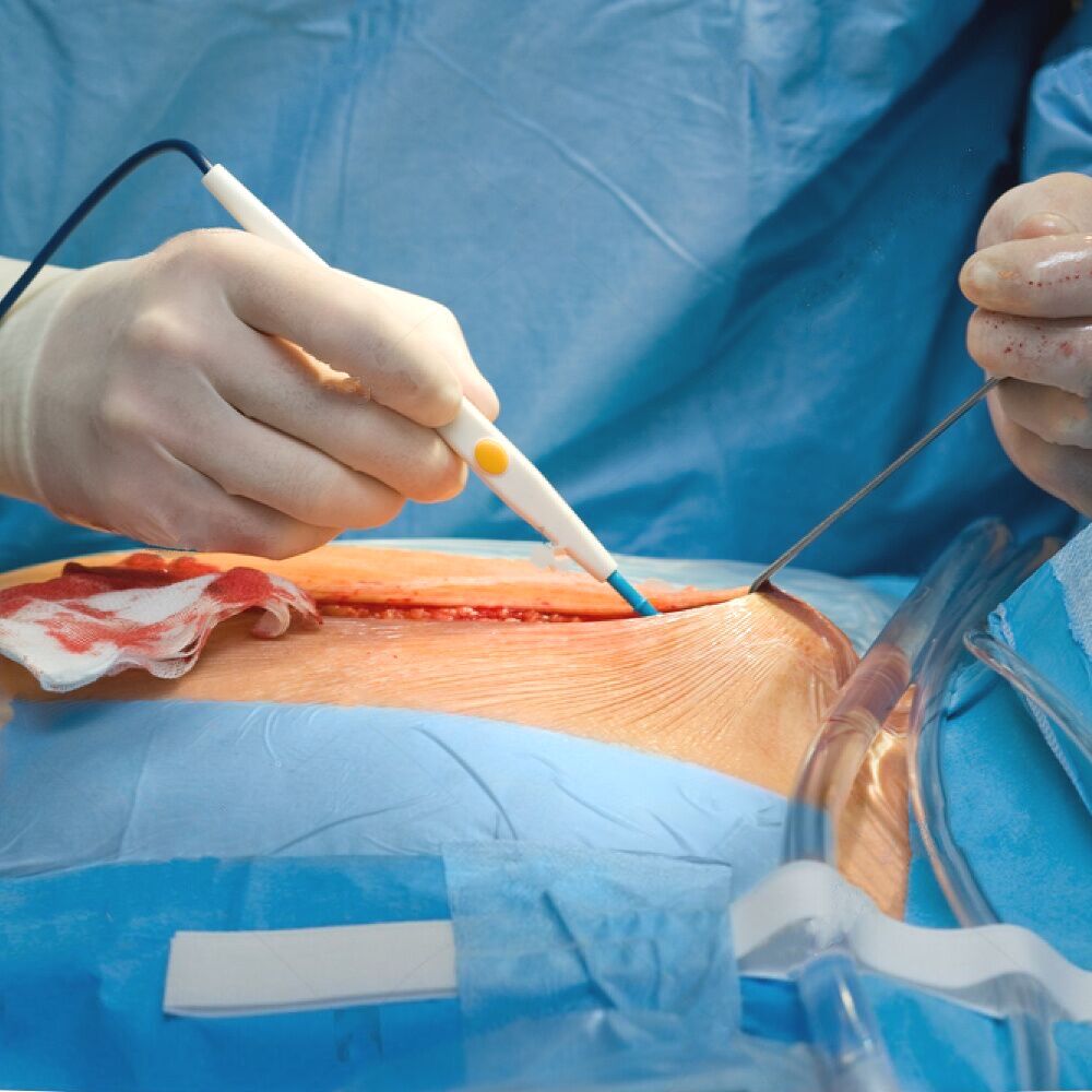 Электрокаутерный электрокоагулятор с кормальным наконечником и многоразовым шпателем