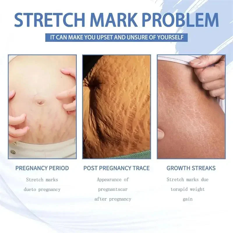 Continued use of Abdominal Scar Removal Cream eliminates signs of swelling, repairs cracks ，fades and improves fine stretch mark