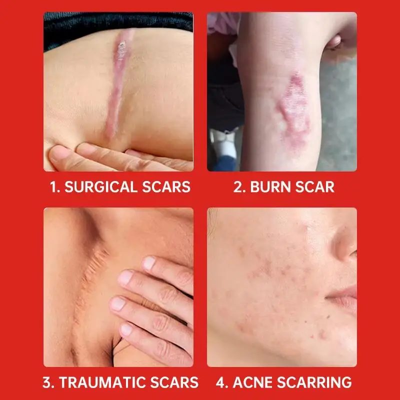 Crema de eliminación rápida de cicatrices, tratamiento efectivo, estrías, quemaduras, cicatrices quirúrgicas, reparación de manchas de acné, blanqueamiento, hidrata, cuidado de la piel a base de hierbas
