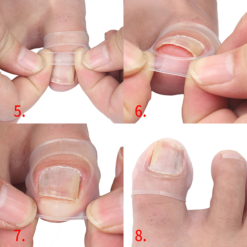 Herramienta de corrección de uñas encarnadas de silicona, Invisible, tratamiento de uñas encarnadas, Clip de alisado elástico, Brace, herramienta de pedicura, 2 piezas