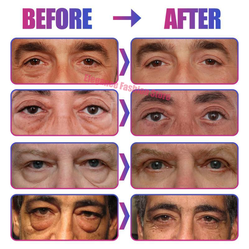 Bolsa de ojos instantánea, crema para eliminar los ojos, partículas antigras, ojeras, hinchazón, decoloración de líneas finas, brillo, belleza coreana, cuidado de los ojos