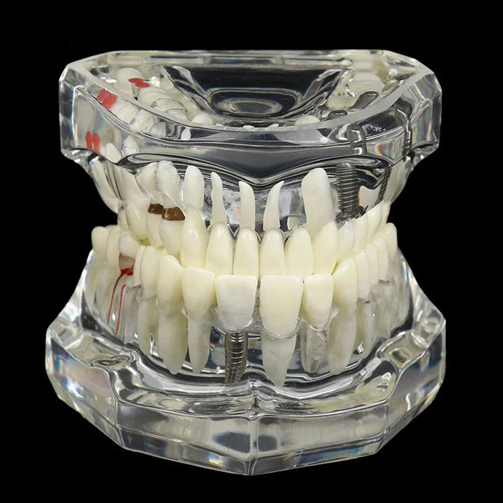 Modelos dentais modelos de resina reparáveis de dentes malentados para ensino e pesquisa em medicamentos e doenças dentárias